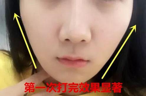 张雨绮打在腋下狐臭处的针,林允缺钱也打了脸