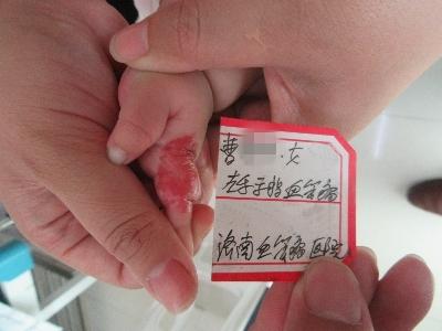 婴幼儿时期的血管瘤可以长大了再治疗吗?血管瘤不治疗会怎么样?