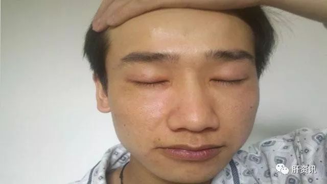 正常的黑皮肤有光泽,皮肤有弹性,肝病造成的肤色晦暗通常有一种