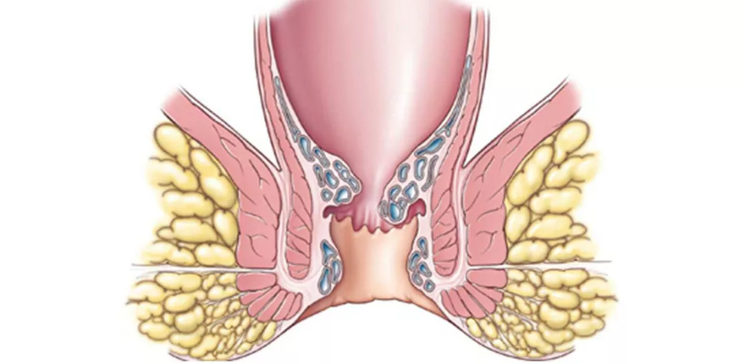 医识|你的肛门有"小馒头"吗?当心了_凤凰网健康_凤凰网