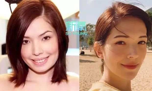 被誉为“宝藏级颜值”女星，惊艳四座后被扒出整形前凸嘴、眯眯眼还没下巴？