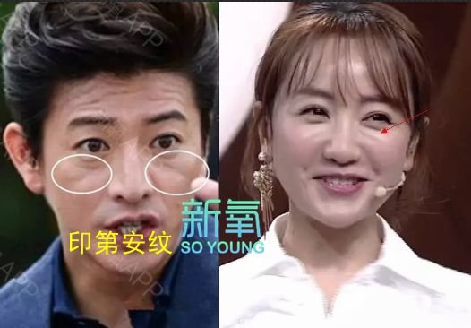 林允儿的神颜也崩了！脸歪+填充成气球，这两道沟又是什么鬼？