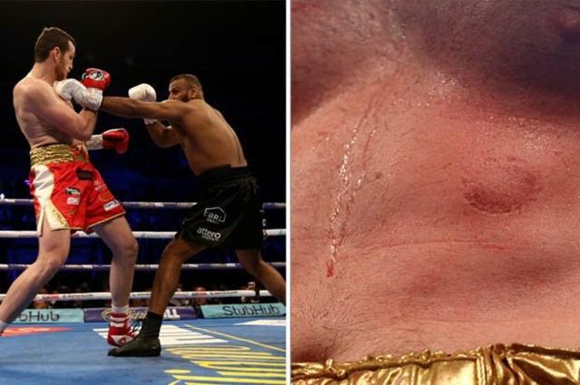重量级拳坛再现泰森式咬人丑闻,中国拳击冠军:应该重罚!