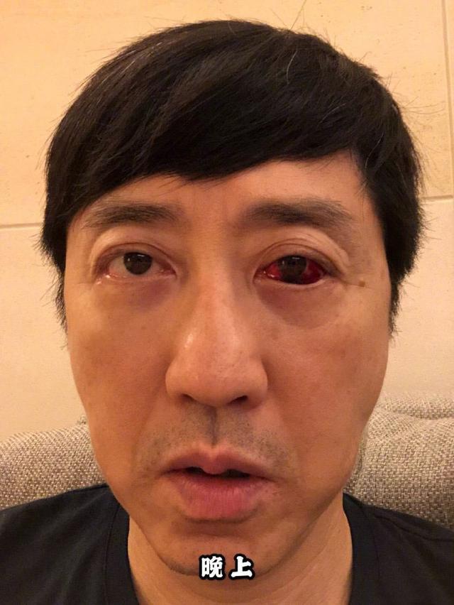 哈林哥庾澄庆晒自拍眼睛受伤严重,网友:有点吓人,快去