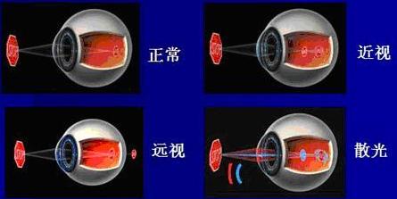 儿童常见的“四类”眼疾,容易致视力模糊