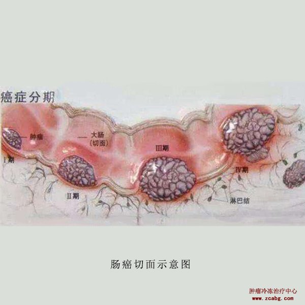 低位直肠癌保肛手术时,一方面强调保留肛门的排便功能,但最重要的是