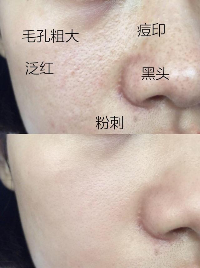 油皮护肤干货万年大油皮毛孔粗大如何内调外养养出光滑好肌肤