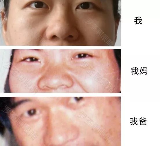 戴近視眼鏡後，真的會「變醜」？眼科醫生坐不住了 健康 第13張