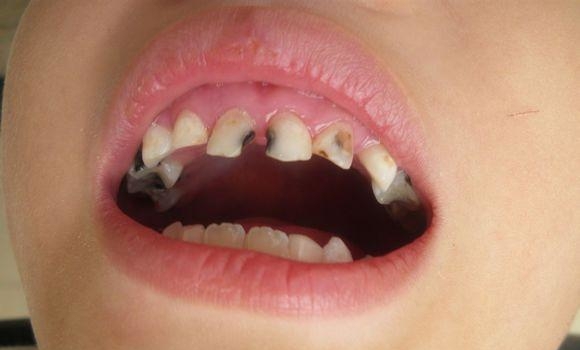 牙齿根部缝隙处发黑有臭味是怎么回事?