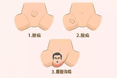 膀胱人口_女性膀胱位置(3)