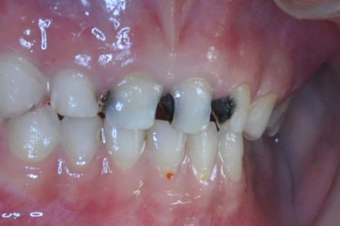 门牙缝发黑是怎么回事?