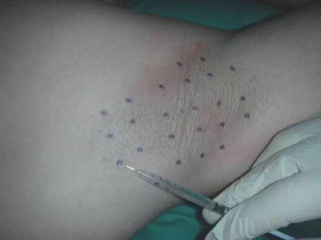 张雨绮打在腋下狐臭处的针,林允缺钱也打了脸