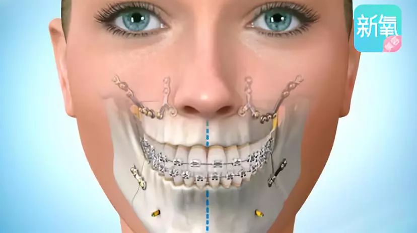 冻龄女神俞飞鸿的苹果肌歪了,她也加入了瞎整