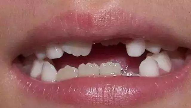 关于孩子换牙期的六大疑问