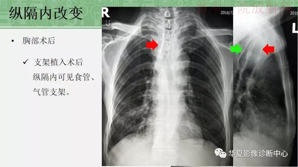 胸部常见疾病x线表现