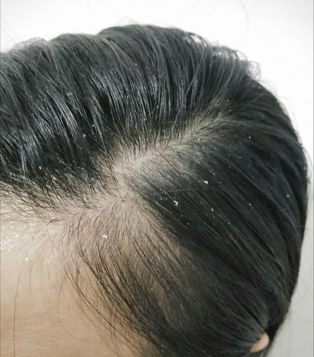 头皮屑多又容易脱发的人，哪些洗发水不能用？哪些洗发水可以用？