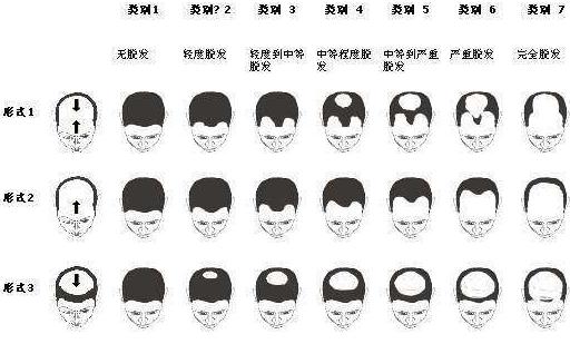 脱发为何多发生在前额和头顶?