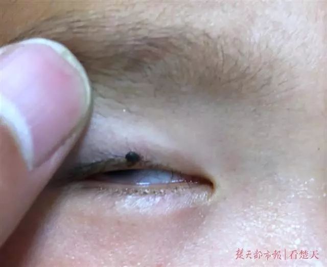 2岁娃眼皮上忽然冒出一个小黑点！医师：这东西会要命！