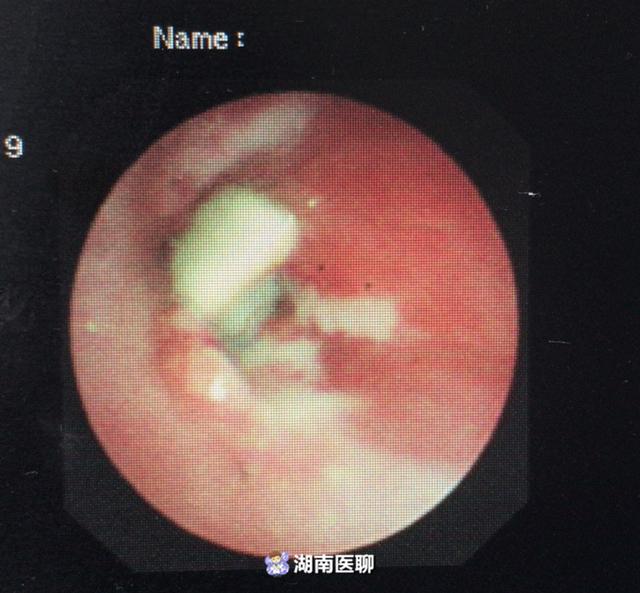 支气管的异物没有取出,所以雾化和药物都是治标不治本,不能起到很好