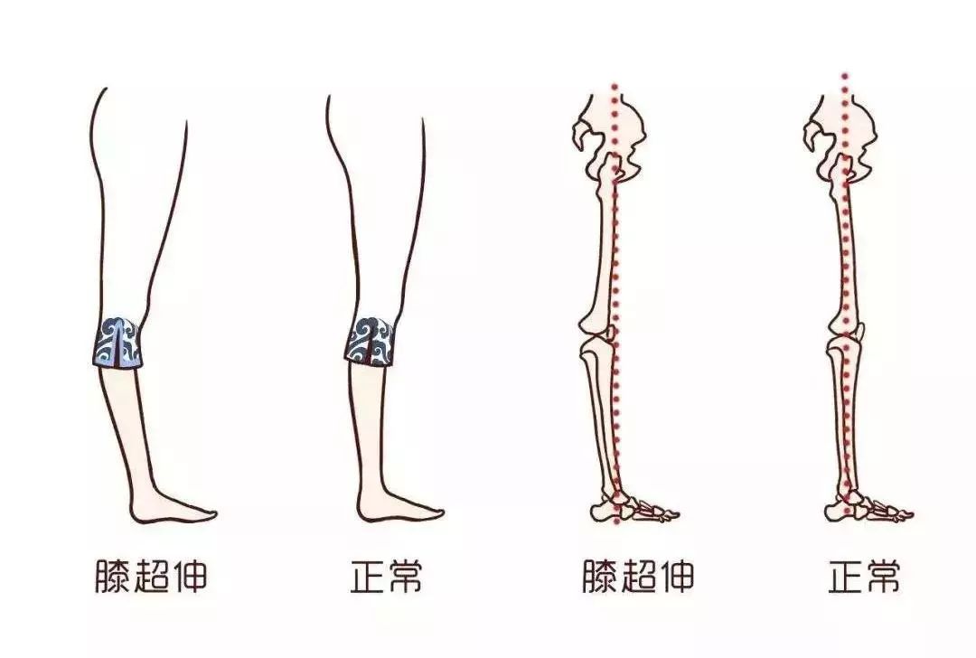 呈现一个前移的状态时, 我们会把重心压在脚后跟, 膝盖就会出现超伸