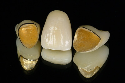 我们该怎样选择适合自己的美容冠?