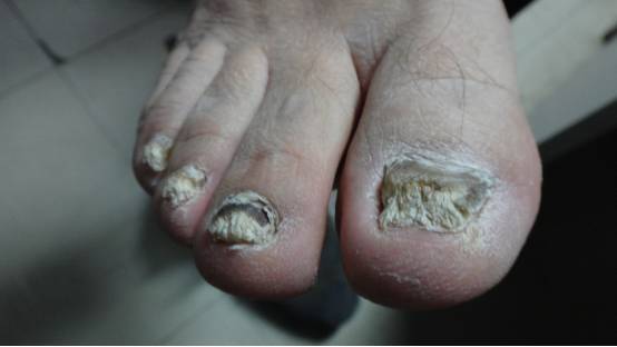 甲癣(灰指甲)的防治_凤凰网健康_凤凰网