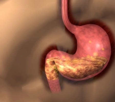 别以为是吃坏肚子,一旦出现胃痛,警惕胃正在癌变