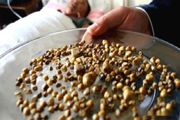 胆结石胆管结石就是这么简单