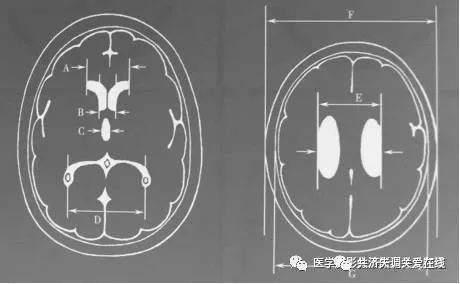 如何鑑別腦萎縮