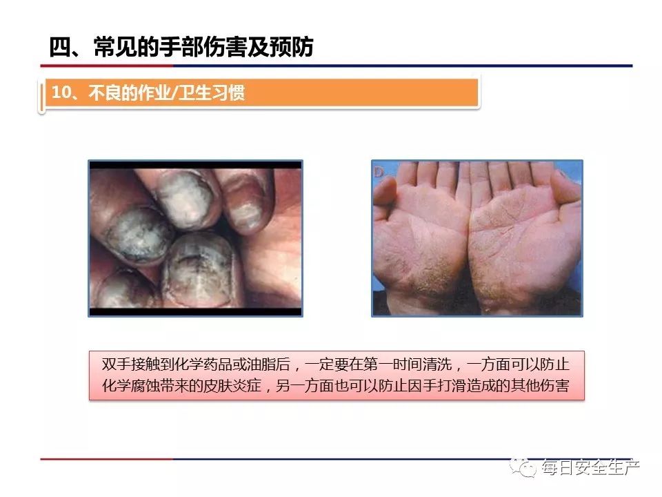 手部受伤事故占所有事故的30%!__凤凰网