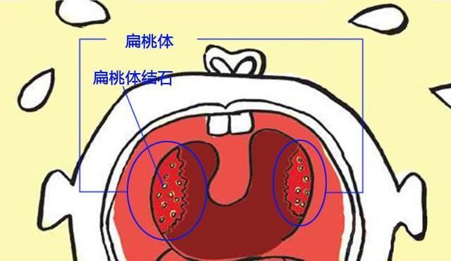 多半是因為扁桃體結石,對著鏡子扣一扣,口臭沒了__鳳凰網