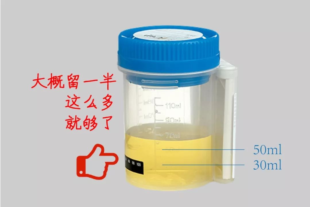 肾友必备:30个尿检常识,第一条你可能就不知道!
