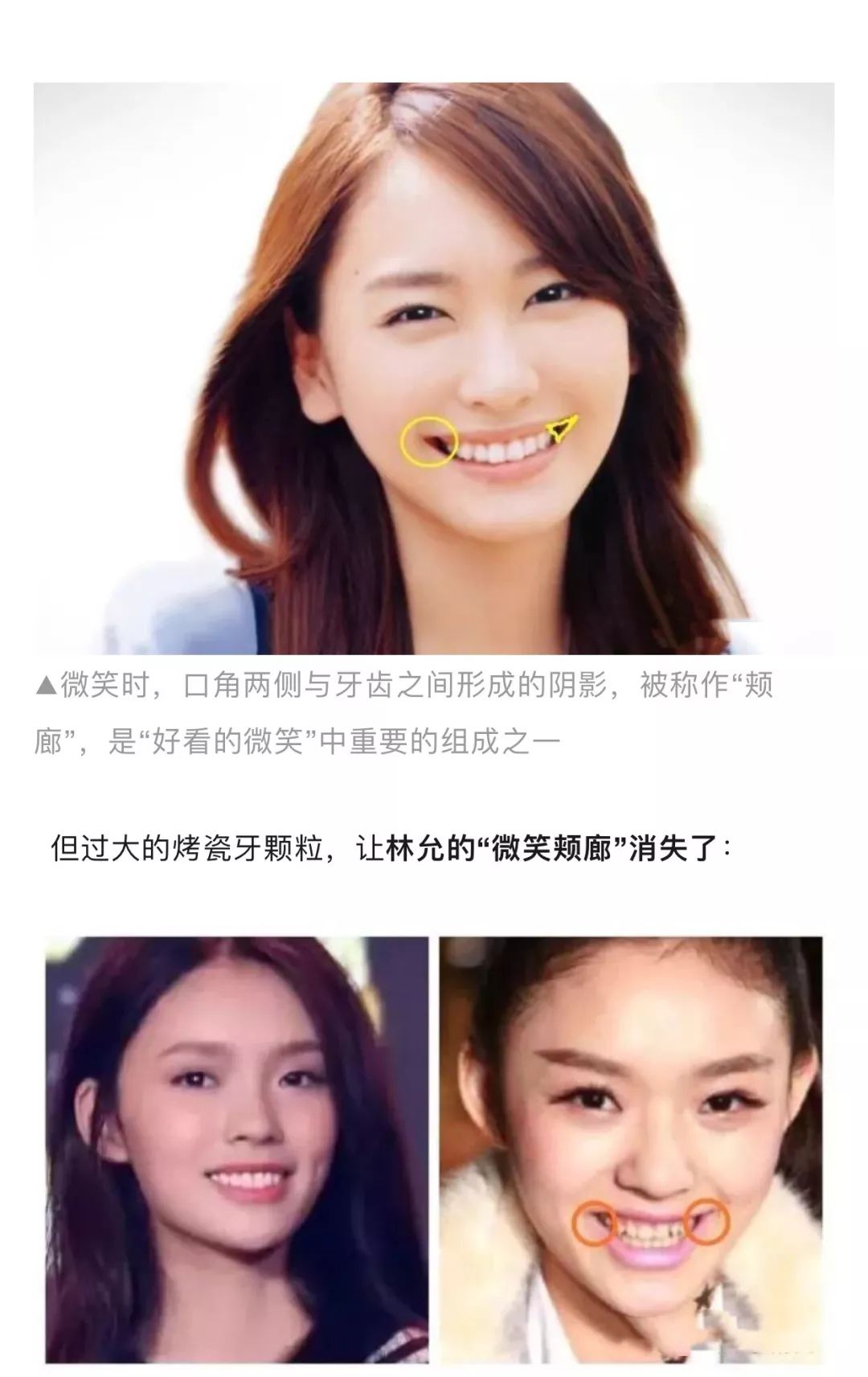 为什么女明星的烤瓷牙反而降低颜值?