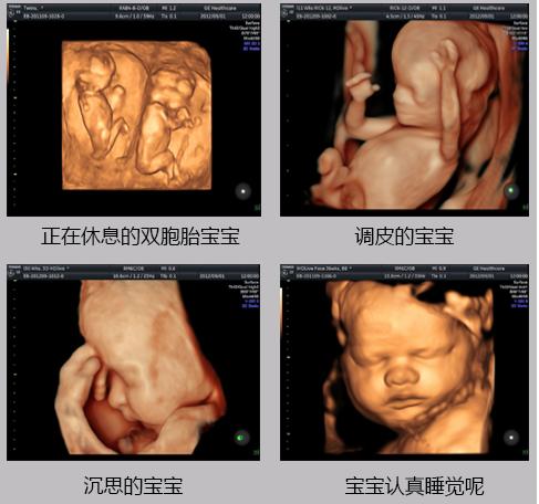 相比三维彩超,它能多方位,多角度,直观,立体地显示胎儿器官的三维结构