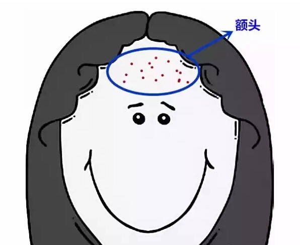 额头长痘痘什么原因六种原因你了解吗