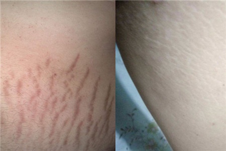 纹管家告诉您如何拯救妊娠纹,生长纹,肥胖纹?