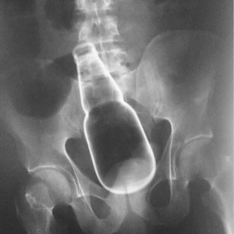 眼球上长毛 脑袋里长牙齿 医生应该见识的22个奇葩病例 凤凰网健康 凤凰网