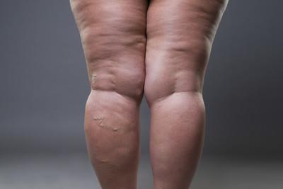 你是脂肪腿还是肌肉腿不同的粗腿瘦腿方法各不同