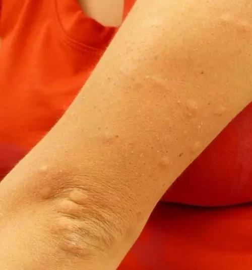 被蚊子咬了个包,又痒又肿地总想挠?停!想快速「止痒消肿」得这样!