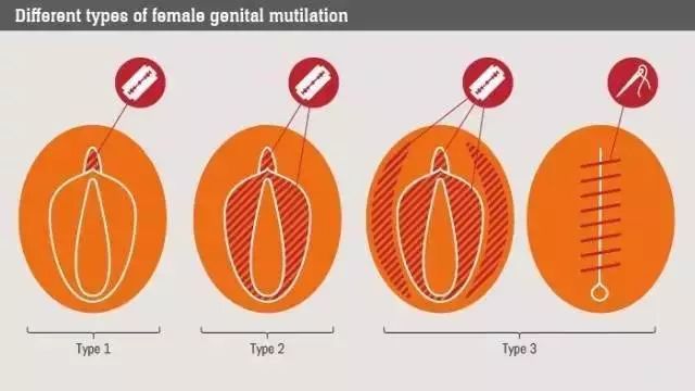 女性割礼图示图片