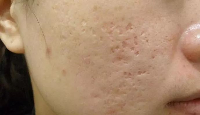 痘坑久治不愈?戳进来看看~__凤凰网