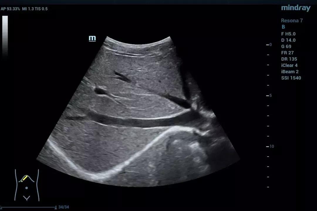 超声提示:胆囊,脾脏检查.肝脏形态大小正常,右叶斜径136.