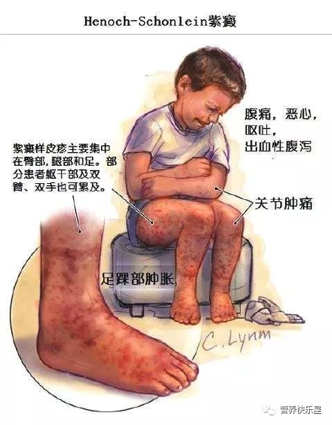 过敏性紫癜营养治疗