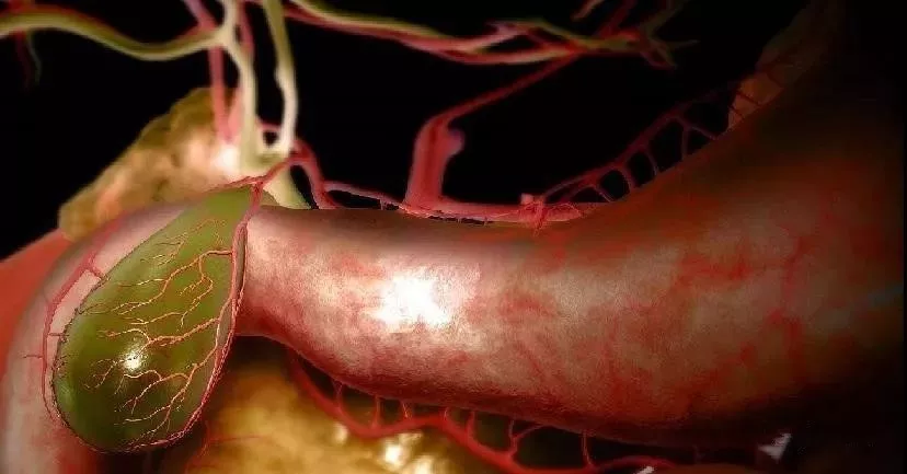 【科普健康】如何正视"体检报告"中的"胆囊息肉"?