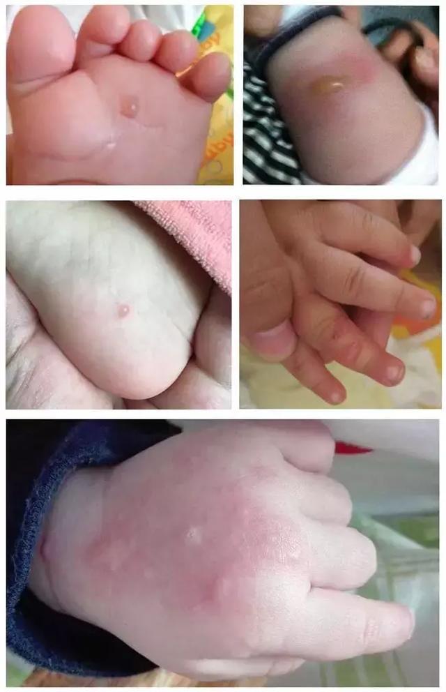 "蚊子还能咬出大水泡?