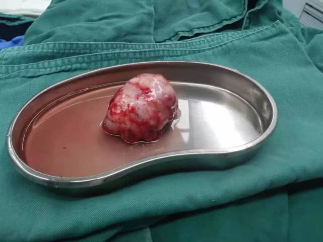 手术切除的肿瘤