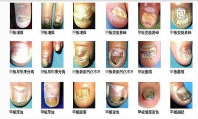 得了灰指甲怎麼辦患上灰指甲有什麼徵兆灰指甲有哪些治療方法