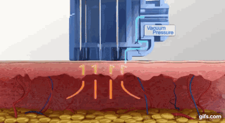 可以试试水光针