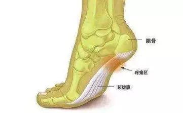 跟骨后滑囊炎跟腱炎是一种常见的骨科疾病,指跟腱内的纤维组织发生了