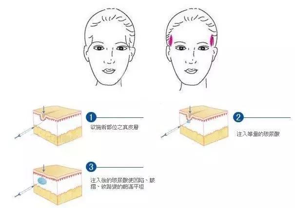 苹果肌重新变得饱满,让面部更加立体,增加年轻感;可以对注射部位精细